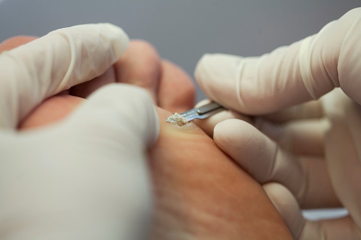 Fodterapeuter  i Region Syd skal behandle fodvorter